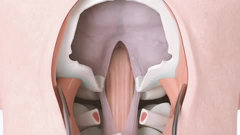 Craniectomy Brain Surgery 3D Animation
