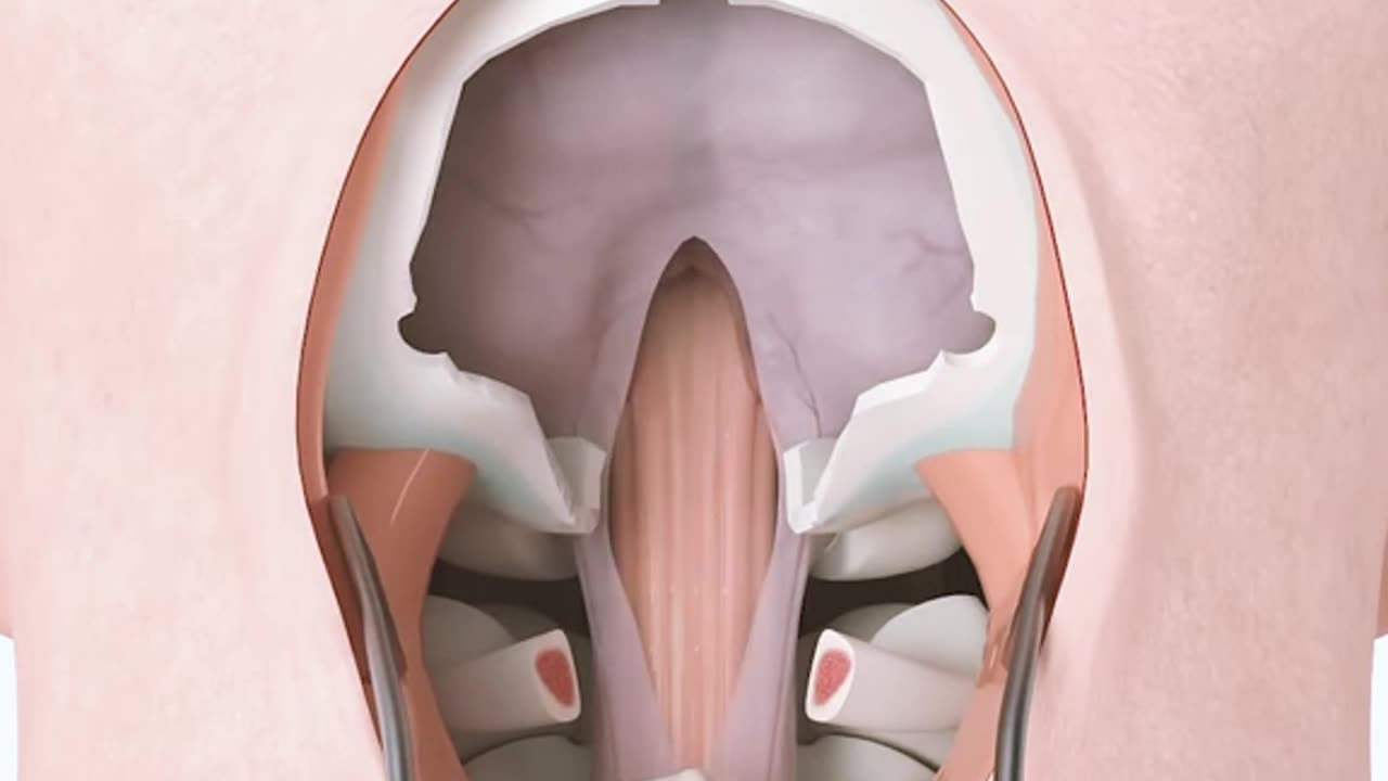 Craniectomy Brain Surgery 3D Animation