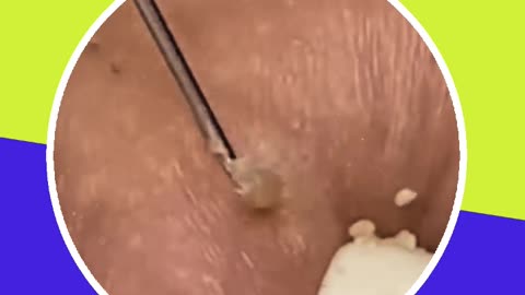 Blackhead removal new this week (ASMR) #4 #shorts