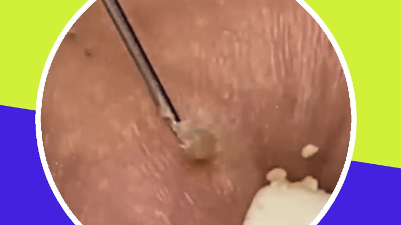 Blackhead removal new this week (ASMR) #4 #shorts