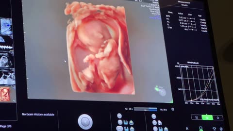 CELEBRATING THE INTERNATIONAL DAY OF THE UNBORN CHILD || foetus, foetalultrasound,