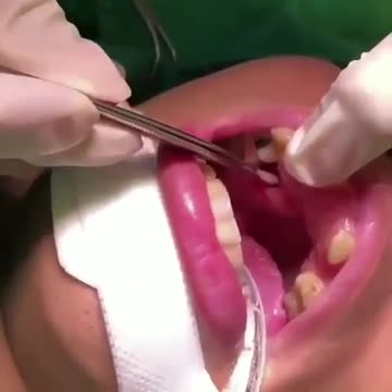 Removal of larvae from gums