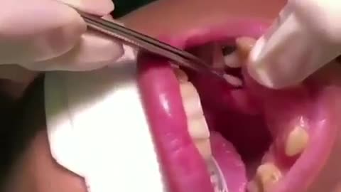 Removal of larvae from gums