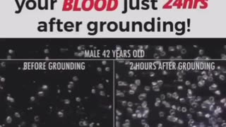 Look What Happens to Your Blood kust 24 hours after Grounding ~ Live longer & be healthier