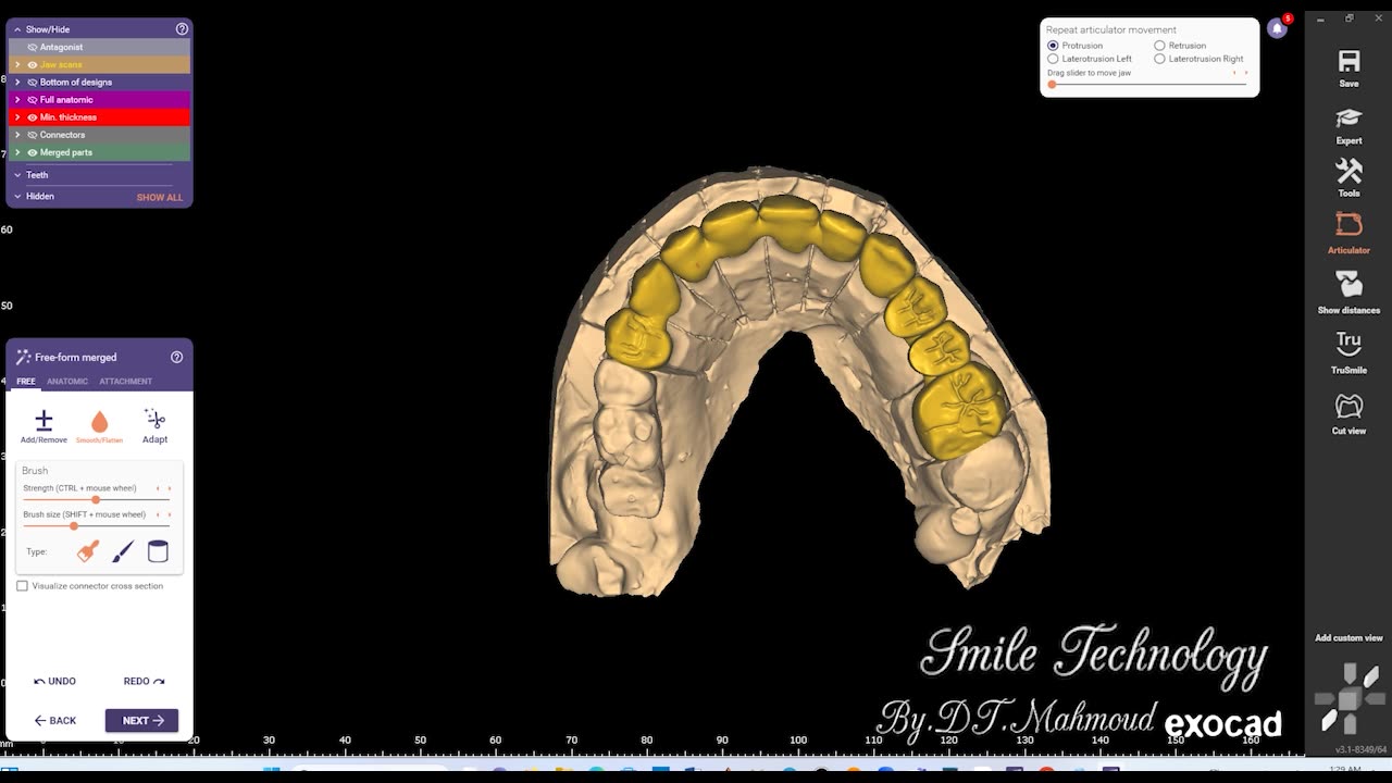 #design #naildesign #dental #dentaldesign #exocadexpert