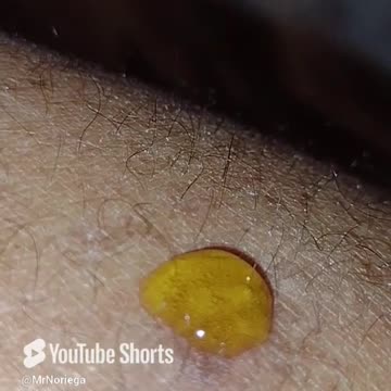 Experimenting with MMS: Kissing bug bite part 2