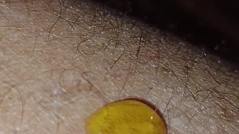 Experimenting with MMS: Kissing bug bite part 2