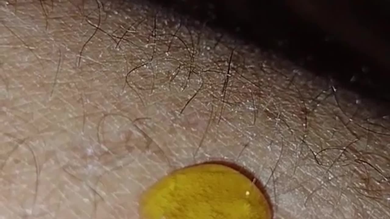 Experimenting with MMS: Kissing bug bite part 2