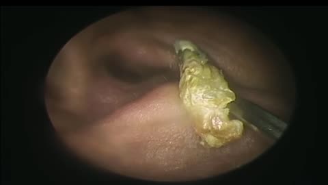 The Itching Stopped after Removing Earwax