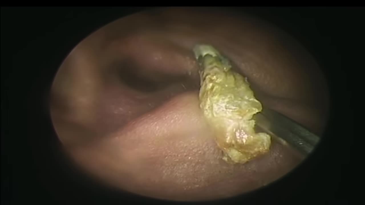 The Itching Stopped after Removing Earwax