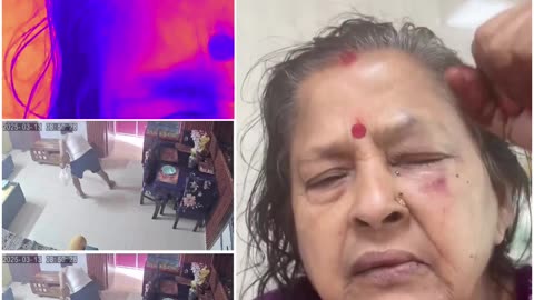 Daughter-in-law From Hell? Woman Bites 78-Year-Old MIL’s Eye, Leaving Her Blind!