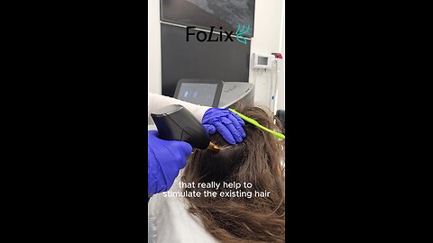 2nd procedure: crown + mid-scalp after 2,500 grafts. Laser-boosted growth. #HairTransplant