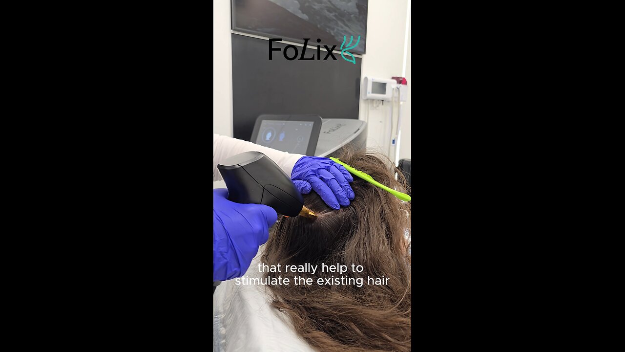 2nd procedure: crown + mid-scalp after 2,500 grafts. Laser-boosted growth. #HairTransplant