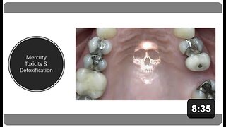 Mercury Detoxification (Dental Fillings)