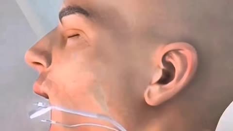 Crossed Eyes Here’s How Strabismus Surgery Gently Realigns Vision!