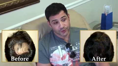 Hair Transplant Result That Speaks for Itself