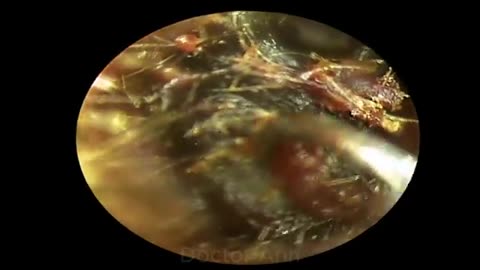 BLACK Earwax Like Chocolate, Difficult Removal