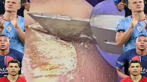 Ingrown Toenail Removal 2025 #ingrowntoenail #toenails #ingrown (22)