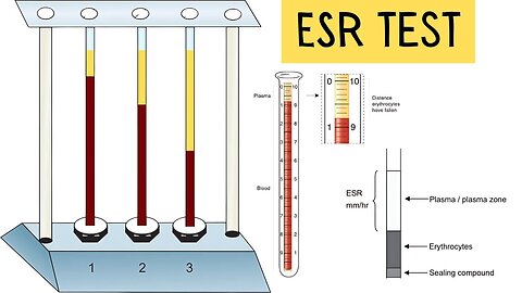 Get the Scoop on the ESR Exam to Decode Your Body’s Clues! MD09