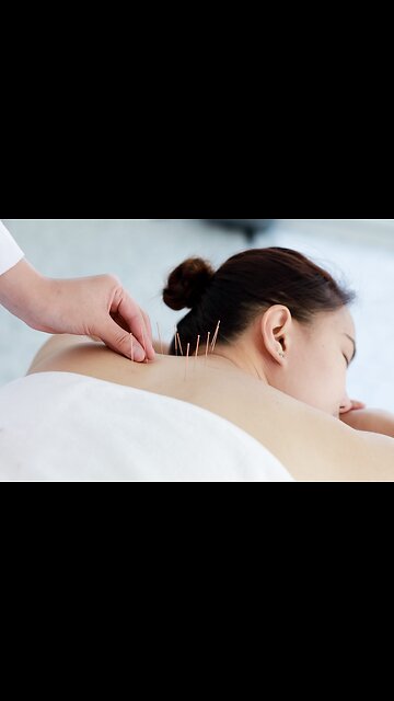 Acupuncture in Toronto: Restore Wellness with Every Needle Point