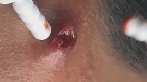 Huge pimple popping satisfying video (ASMR) #1