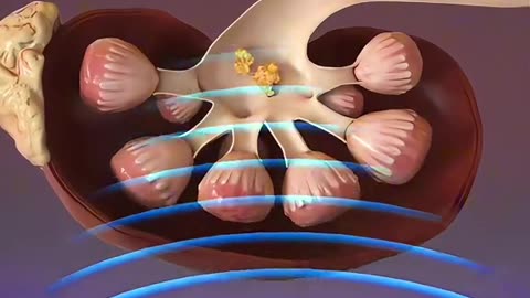 Shockwave Lithotripsy (3D Animation) Kidney Stones Removal