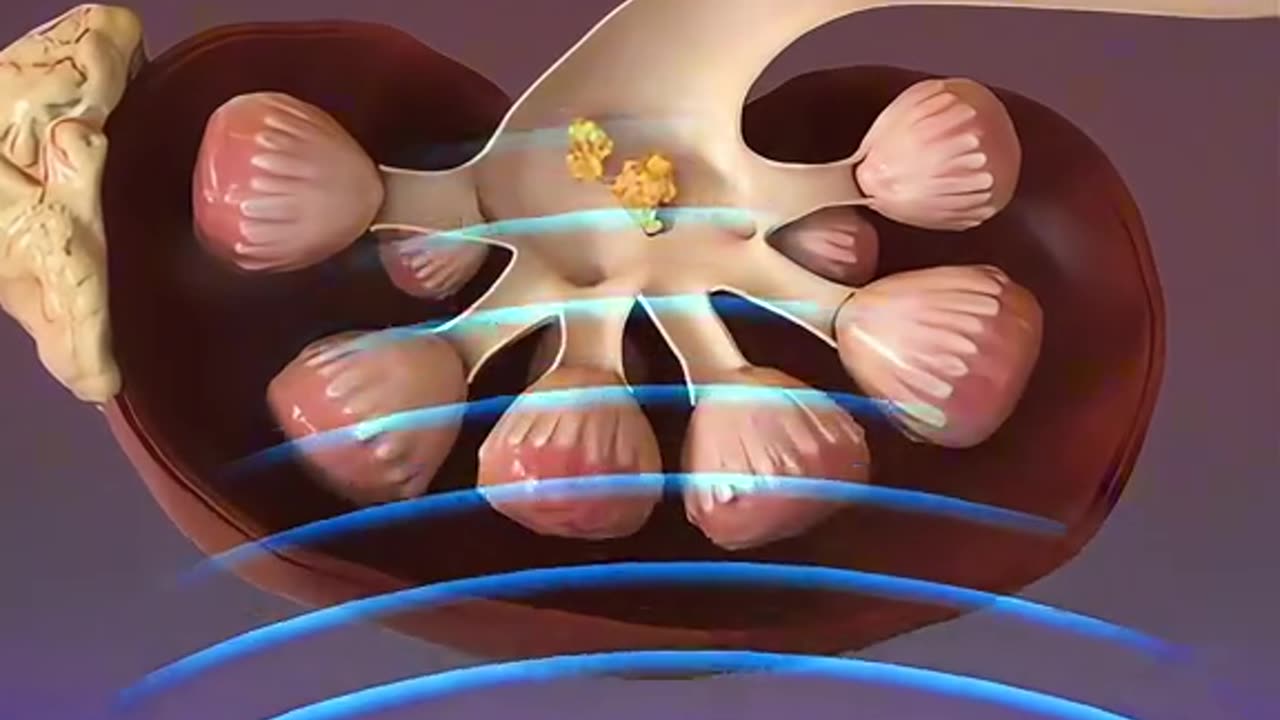 Shockwave Lithotripsy (3D Animation) Kidney Stones Removal