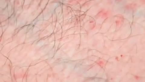 What Causes Acne? | The Truth You Need to Know