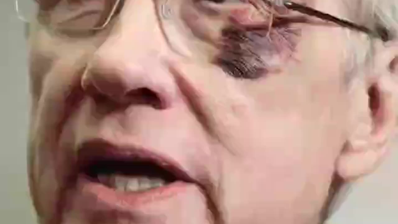 Ever Wonder Why So Many Famous People Suddenly Have A Black Eye