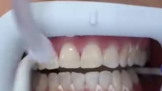 Amazing: Laser teeth whitening before and after #shorts #teethwhitening #dentis