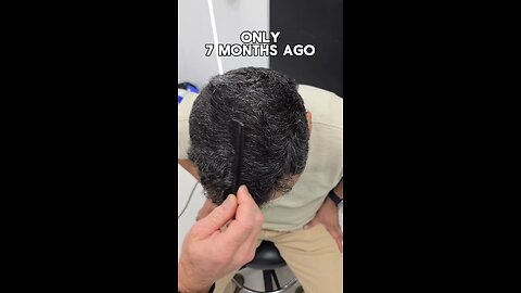 Incredible results from a hair transplant! Restore your confidence today!