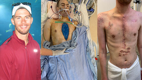 After being Vaccinated, my Son required at Heart Transplant.