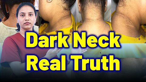 Skin Darkening Truth: PCOS vs Diabetes | Treatment Cure Medicine | Gynaecology | Homeopathy