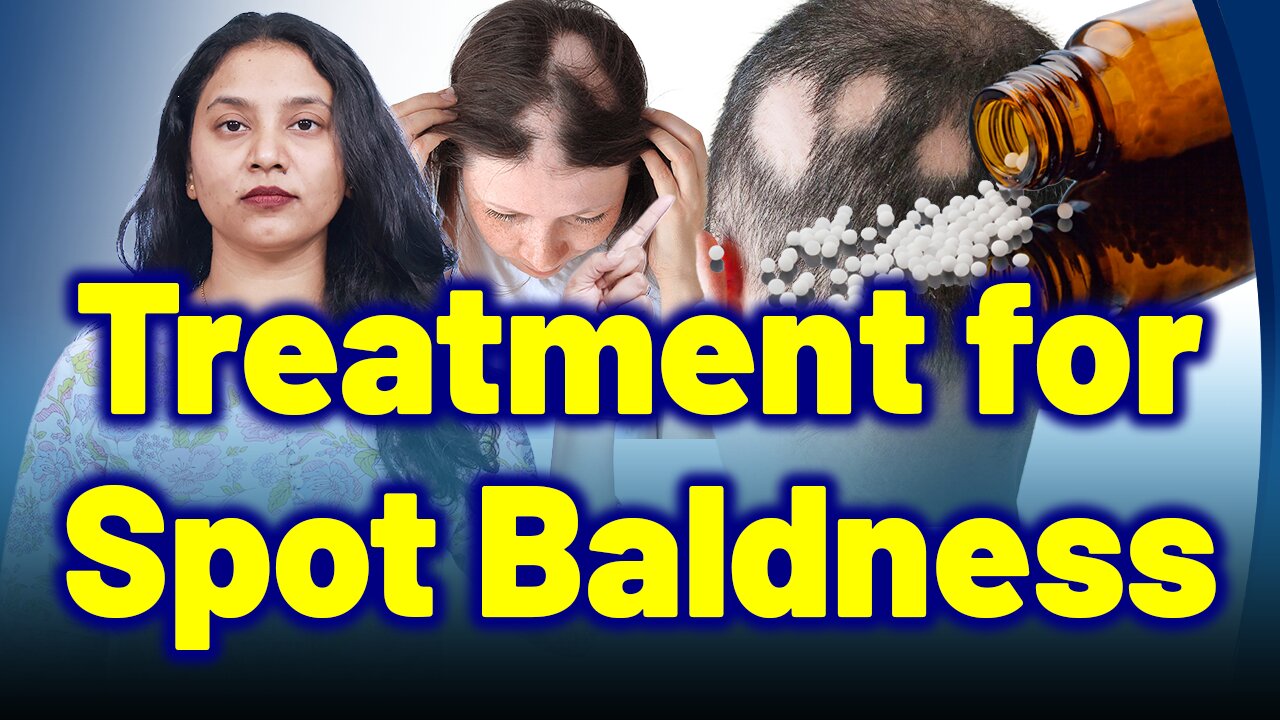 Treatment for Alopecia Areata, Patchy Baldness.| Treatment and Cure | Homeopathy, Medicine & Surgery