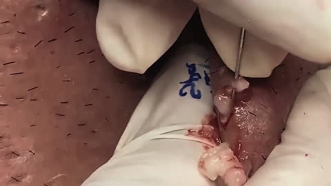 Blackheads Removal | Acne Treatment and Very Satisfying Satisfying Pimple pop (ASMR) #4 #blackheads