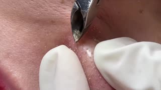 Blackhead Removal With Tweezer (1 Hour)