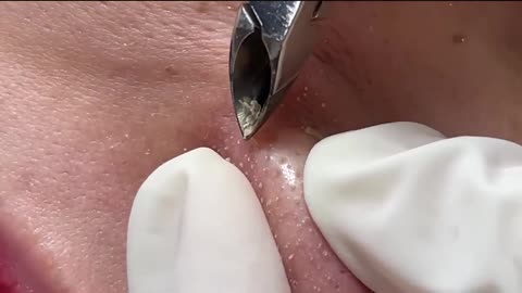 Blackhead Removal With Tweezer (1 Hour)