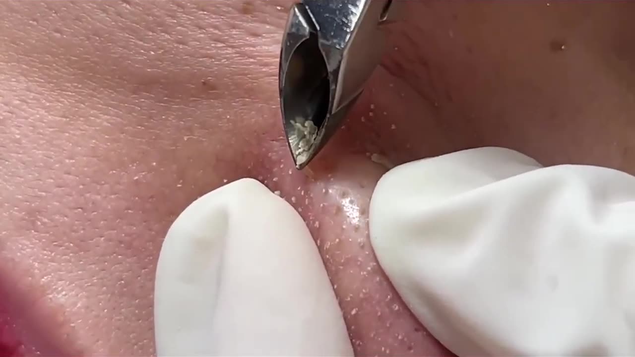 Blackhead Removal With Tweezer (1 Hour)