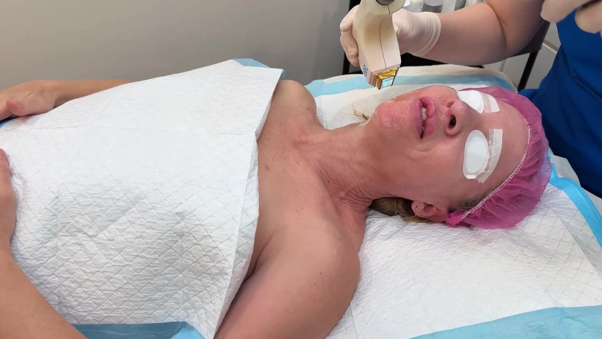 My BBL Hero Treatment Experience at Laser Clinics Australia: Unlocking Youthful Skin!