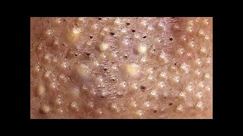 Blackheads Removal & Pimple Popper Cystic Acne Extraction #226