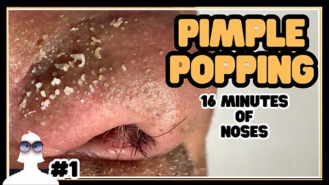 Nose PIMPLE POPPING Episode #1