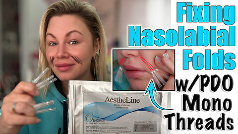 Fixing Nasolabial Folds w/ PDO Mono Threads, AceCosm.com and code Jessica10 Saves