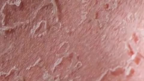How UV Rays Burn Your Skin in Minutes | Protect Yourself from Sun Damage