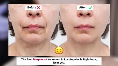 Morpheus8 at Skin Works Medical Spa