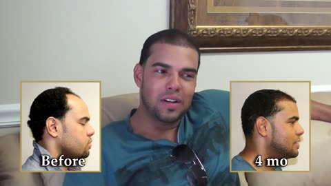 Dr. Brett Bolton Young Male Gets his Youthful Hairline Back in Only 4 months