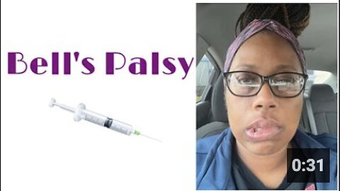 "Understanding Bell's Palsy: Causes, Symptoms and Treatments"