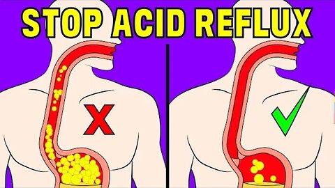 How to Naturally Fix Acid Reflux and Heartburn without Medication
