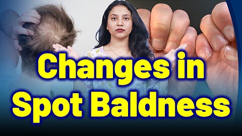 Changes in Alopecia Areata, Patchy Baldness | Treatment Cure Medicine Skin Hair Nail | Homeopathy