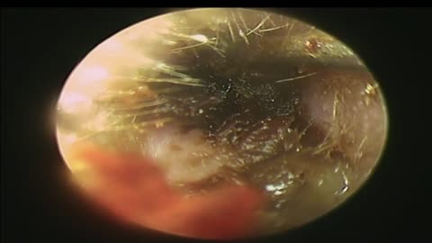 SEVERE Earwax Blockage Removal Both Ear