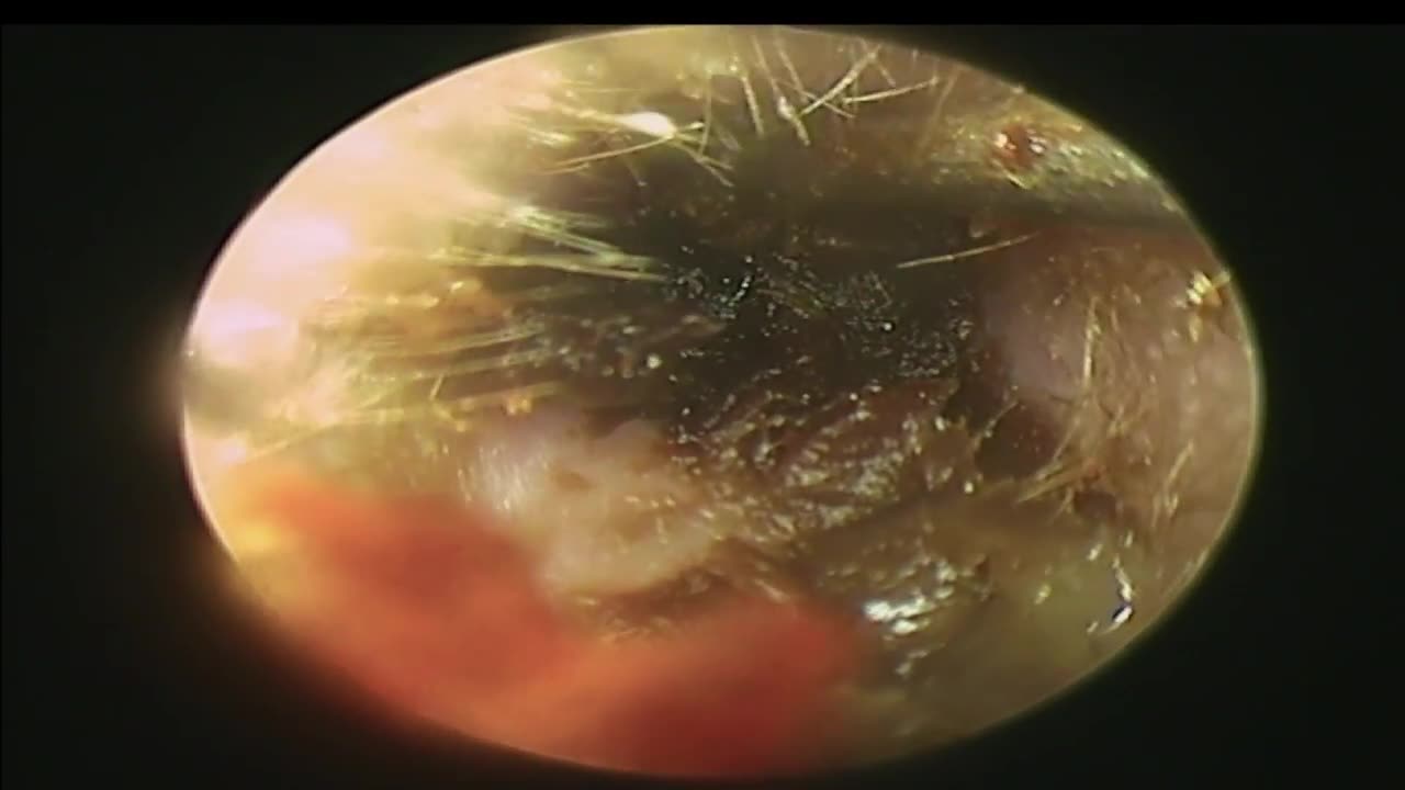 SEVERE Earwax Blockage Removal Both Ear